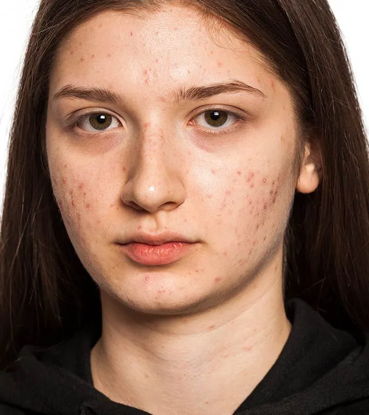 Before Acne Remove Hypic Prompt